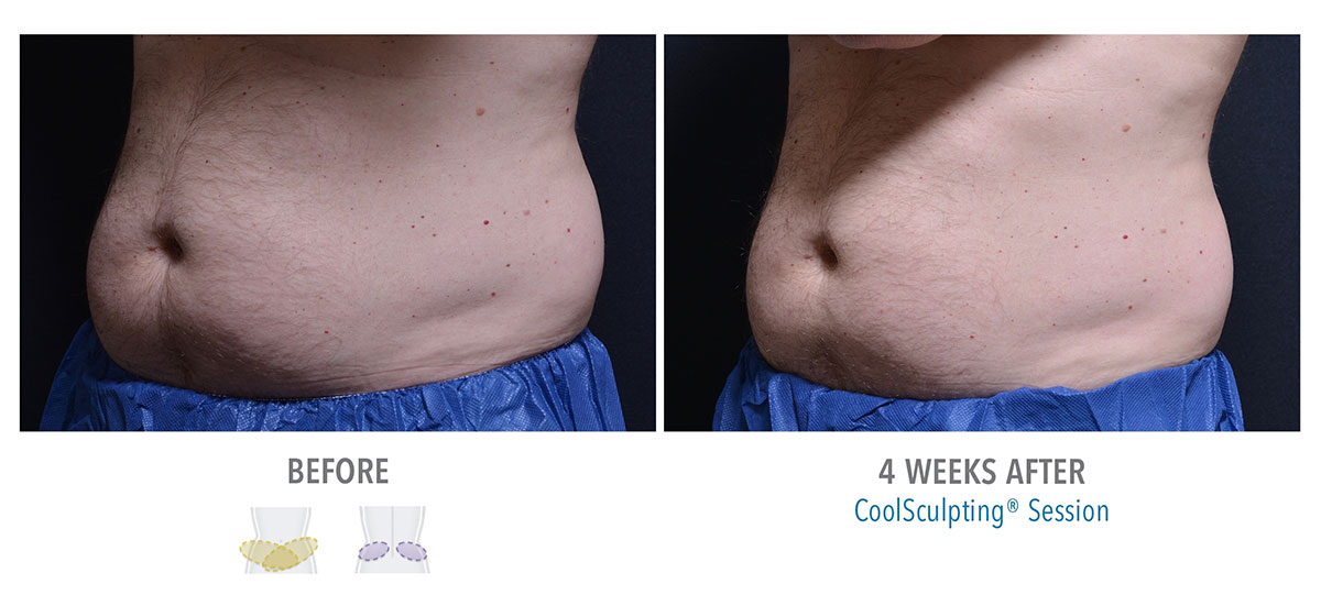 before and after coolsculpting