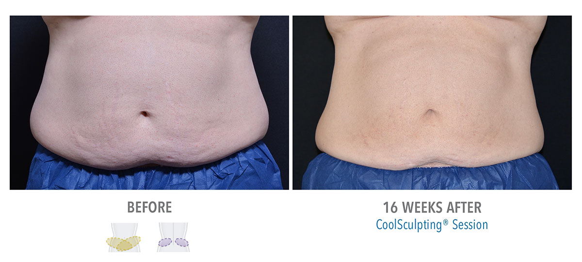 before and after coolsculpting