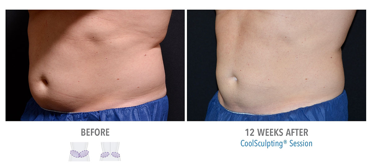 before and after coolsculpting