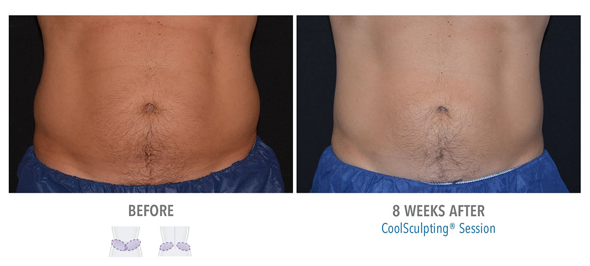 before and after coolsculpting