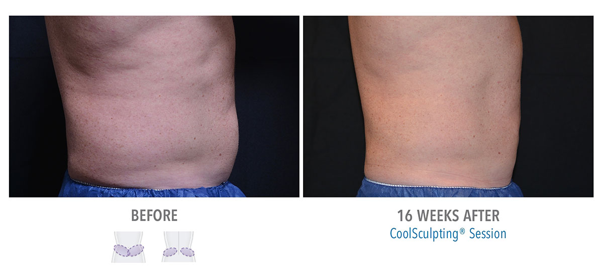 before and after coolsculpting