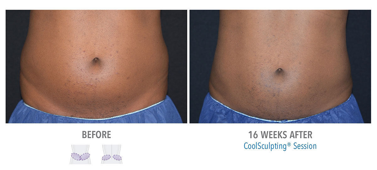 man after coolsculpting for stubborn belly fat hendersonville