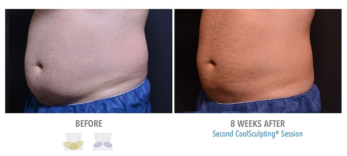 before and after coolsculpting