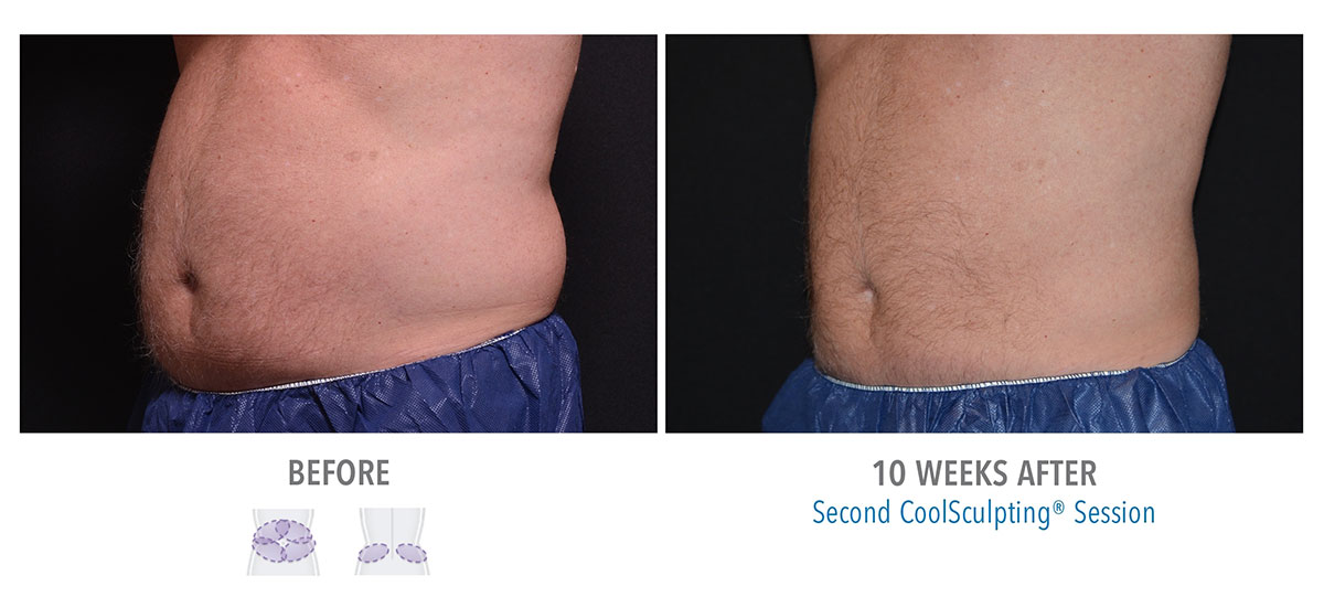 man after coolsculpting for stubborn belly fat hendersonville