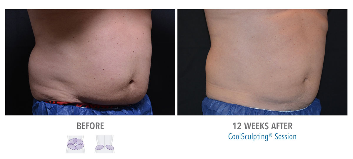 before and after coolsculpting