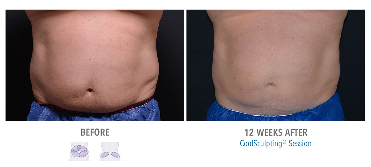 before and after coolsculpting