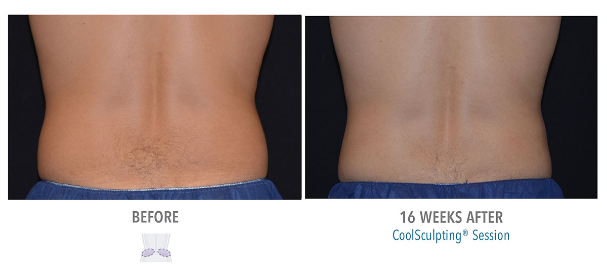 before and after coolsculpting