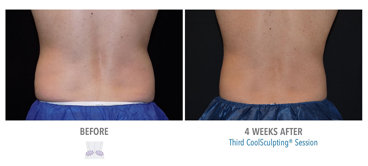 before and after coolsculpting