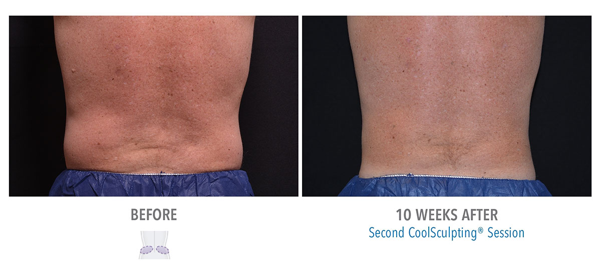 before and after coolsculpting for love handles and muffin top hendersonville