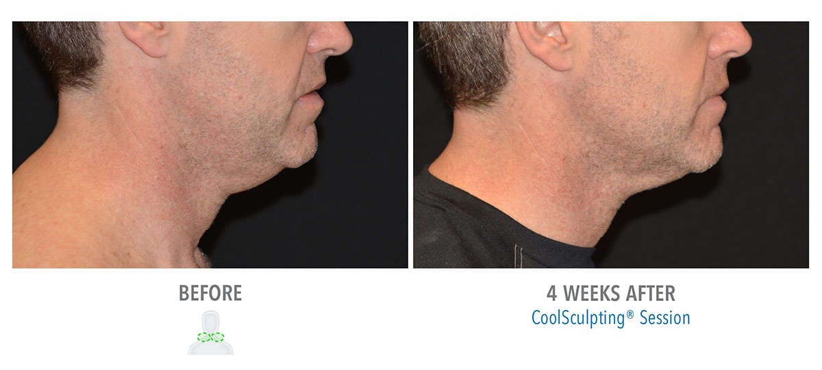 before and after coolsculpting