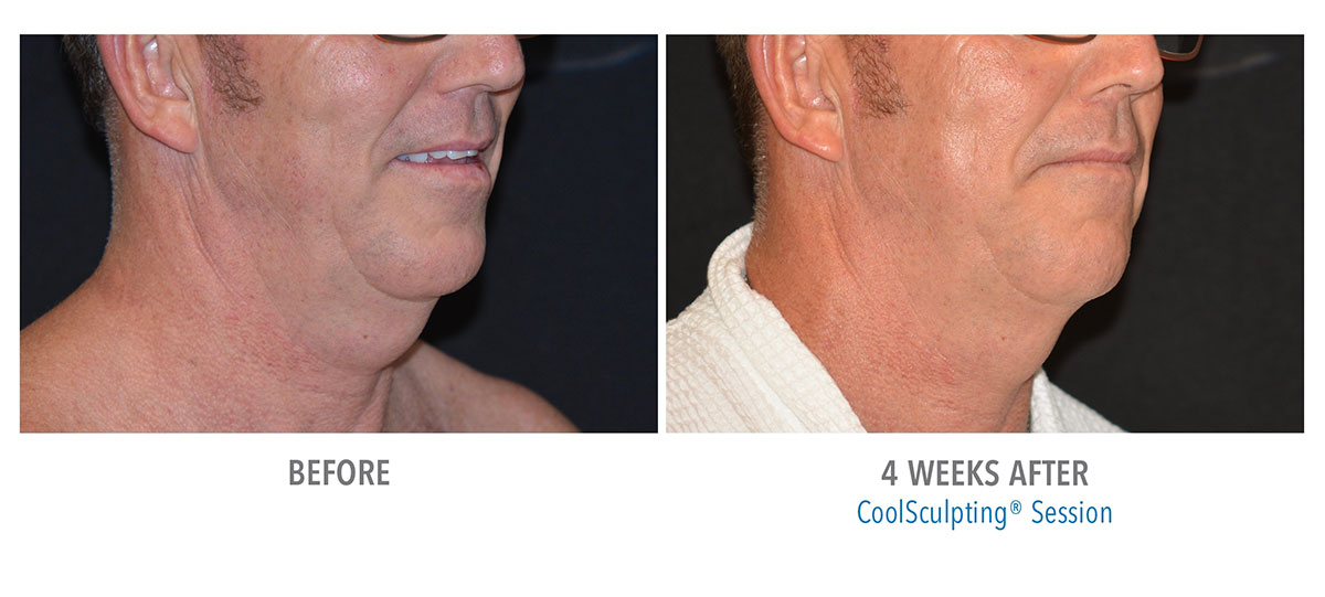 before and after coolsculpting