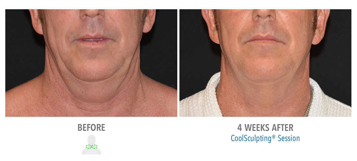 before and after coolsculpting