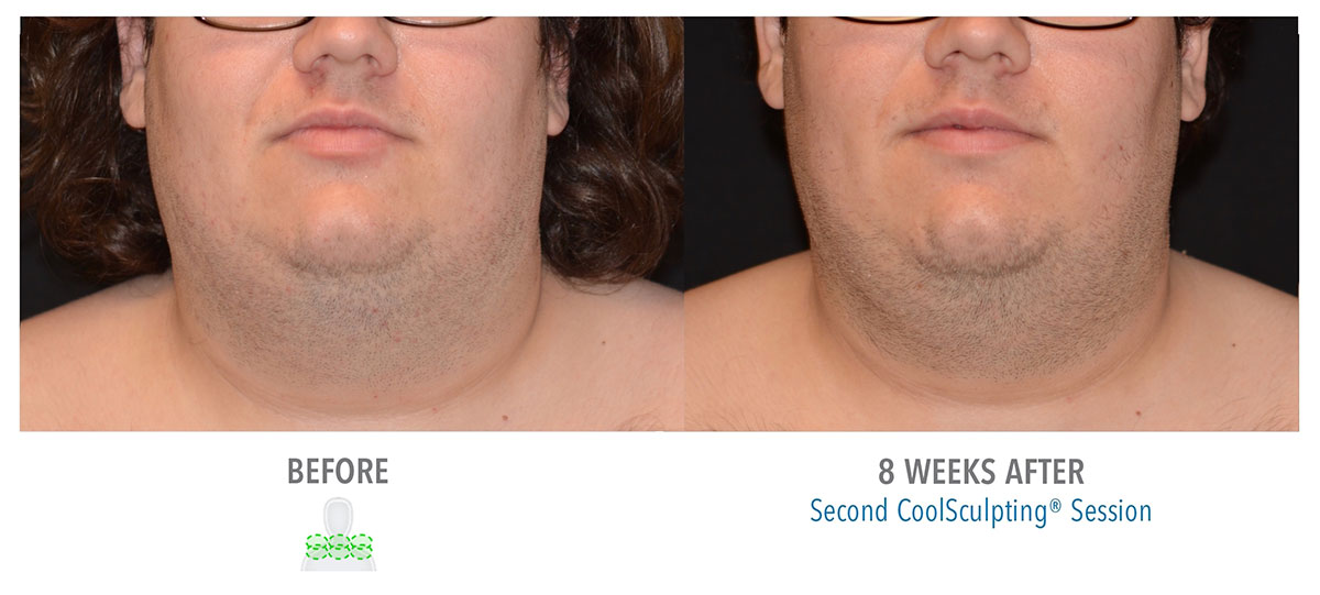 before and after coolsculpting