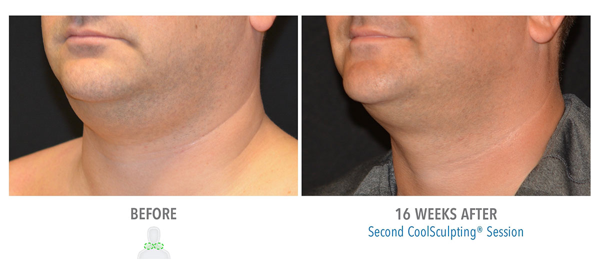 before and after coolsculpting