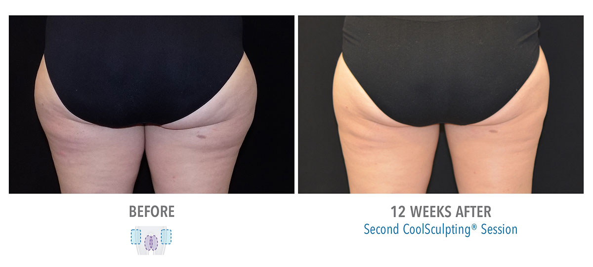 before and after coolsculpting