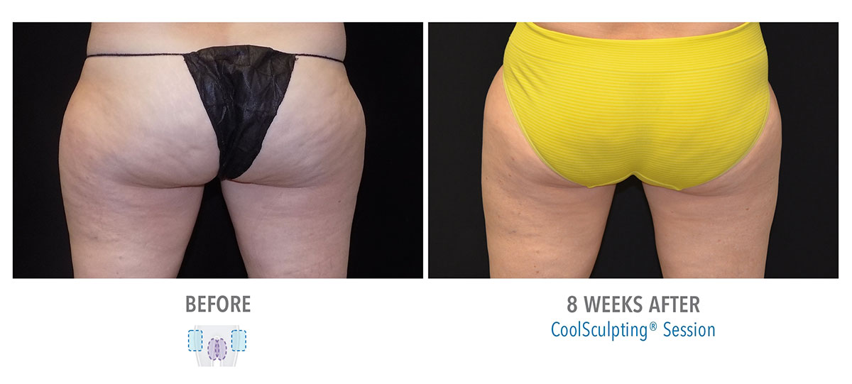 before and after coolsculpting for leg fat hendersonville