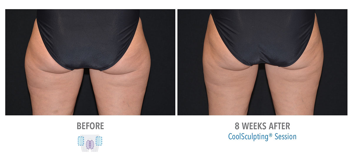 before and after coolsculpting