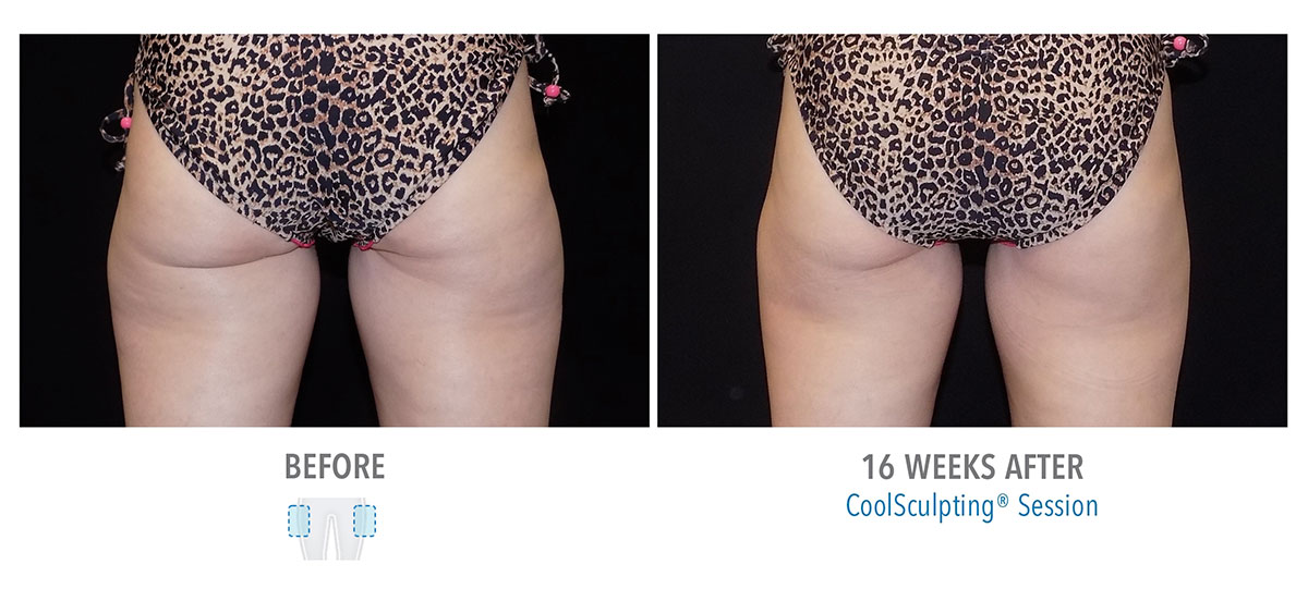 before and after coolsculpting