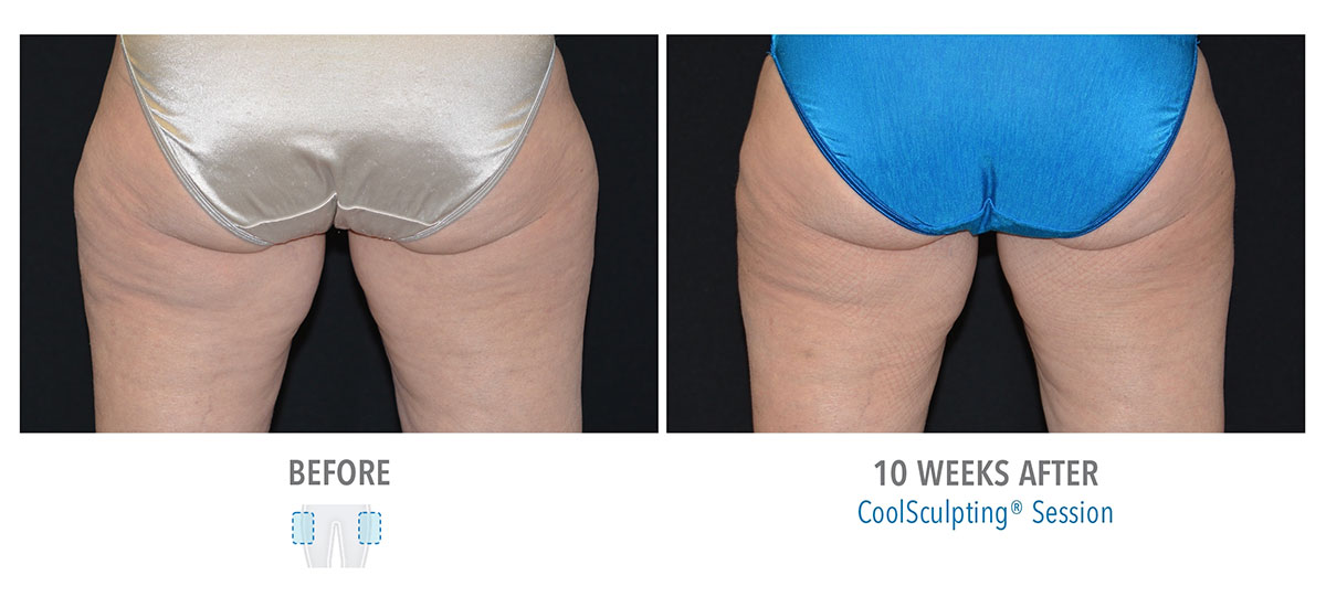 before and after coolsculpting for leg fat hendersonville