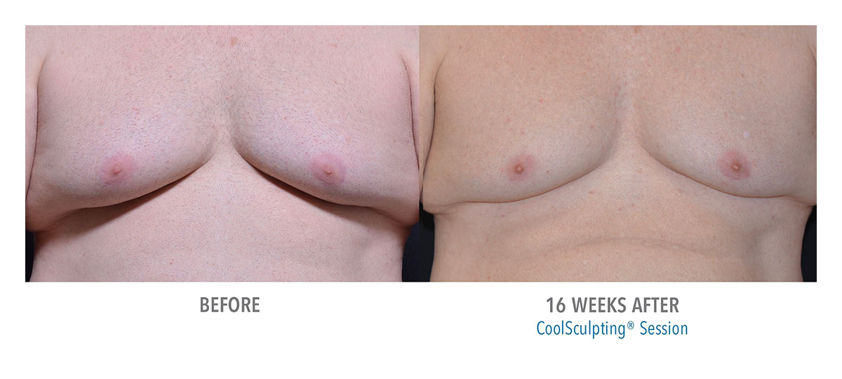 before and after coolsculpting for gynecomastia hendersonville