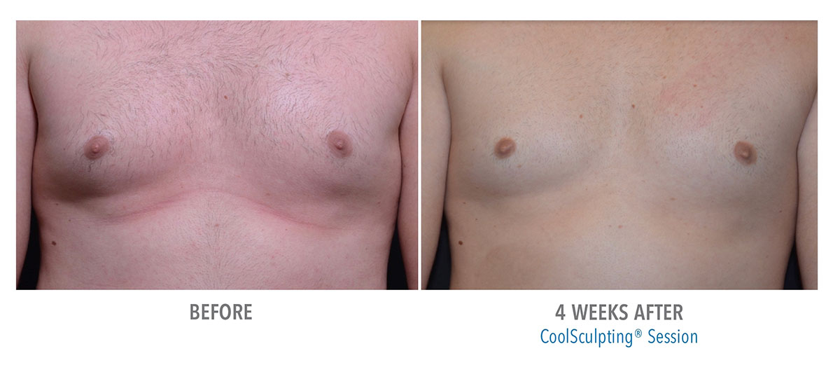 before and after coolsculpting for gynecomastia hendersonville