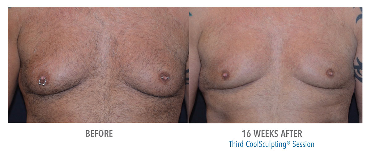 before and after coolsculpting for gynecomastia hendersonville