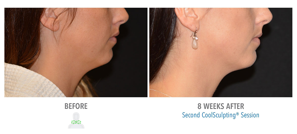 before and after coolsculpting on neck fat hendersonville