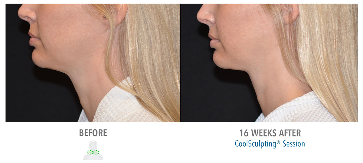 before and after coolsculpting on neck fat hendersonville