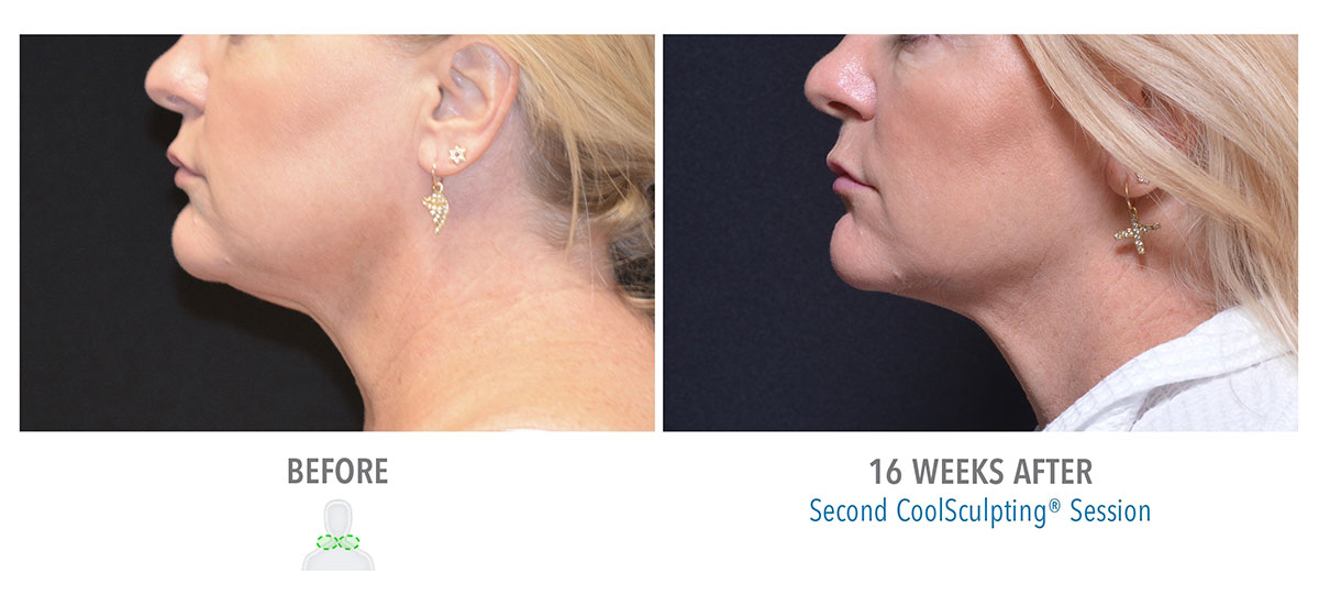 before and after coolsculpting