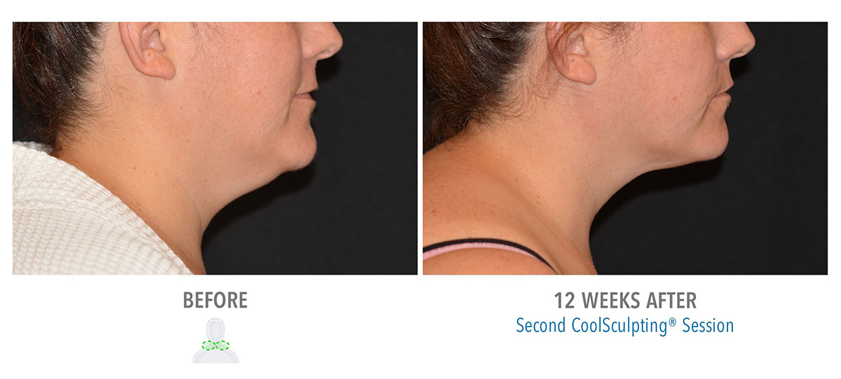 before and after coolsculpting